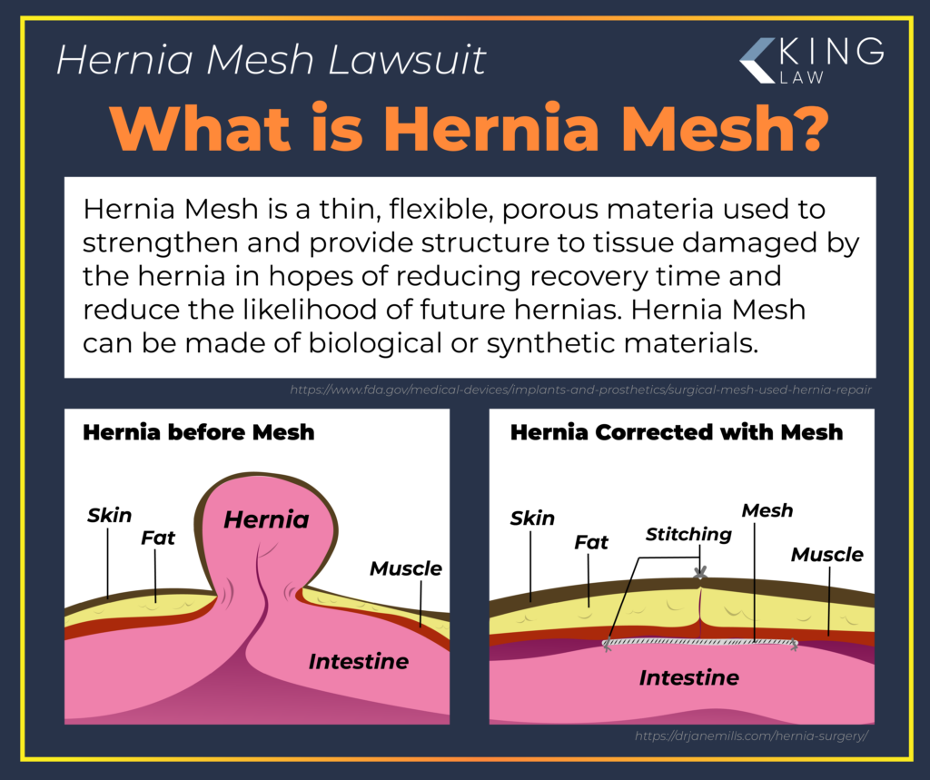 Infographic defining what hernia mesh is