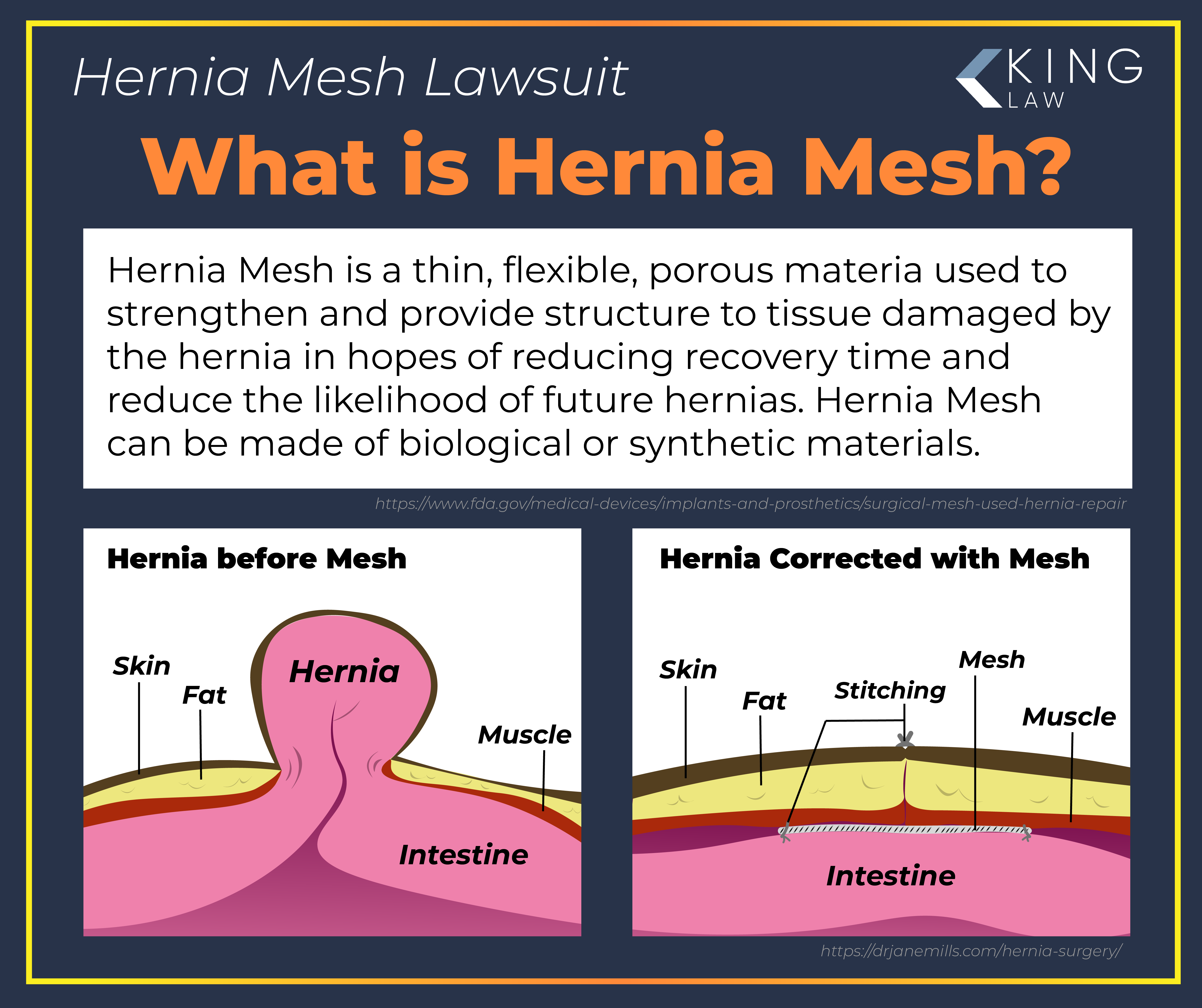 Hernia Mesh Lawsuit - March 2024 Updates and Settlements