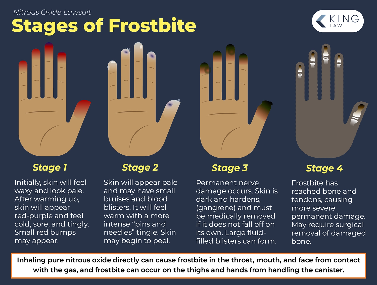 Infographic showing a simple rendering of what frostbite might look like on the hands and the severity of each stage.